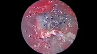 Surgery Procedure 1